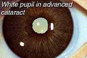 Advanced Cataract